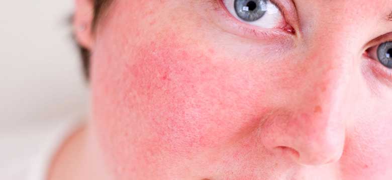 Rozasea, Egzama, Seboreik Dermatit ve Hassas Ciltler İçin Etkili Çözüm: Azulen Serisi!