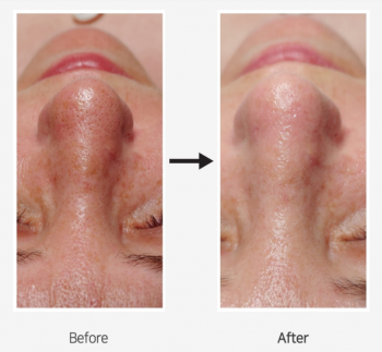 BLACKHEAD & PORE CLEAN LOTION 1000ml